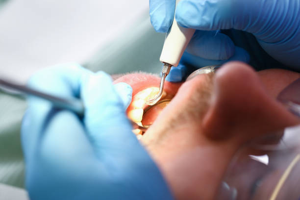 Best Emergency Tooth Extraction in Bloomfield, IA
